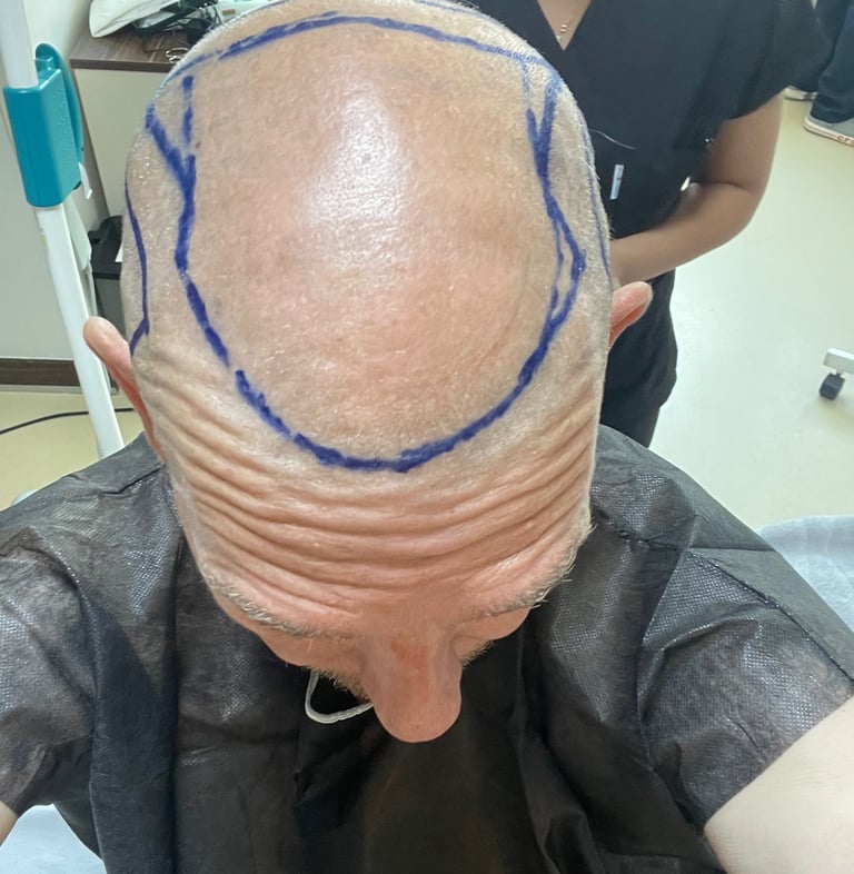My head being prepared for hair transplant surgery in Izmir, Turkey