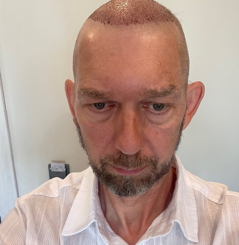 post operation pictures of a hair transplant on a man