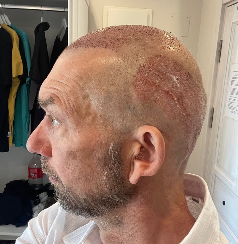 post operation pictures of a hair transplant on a man