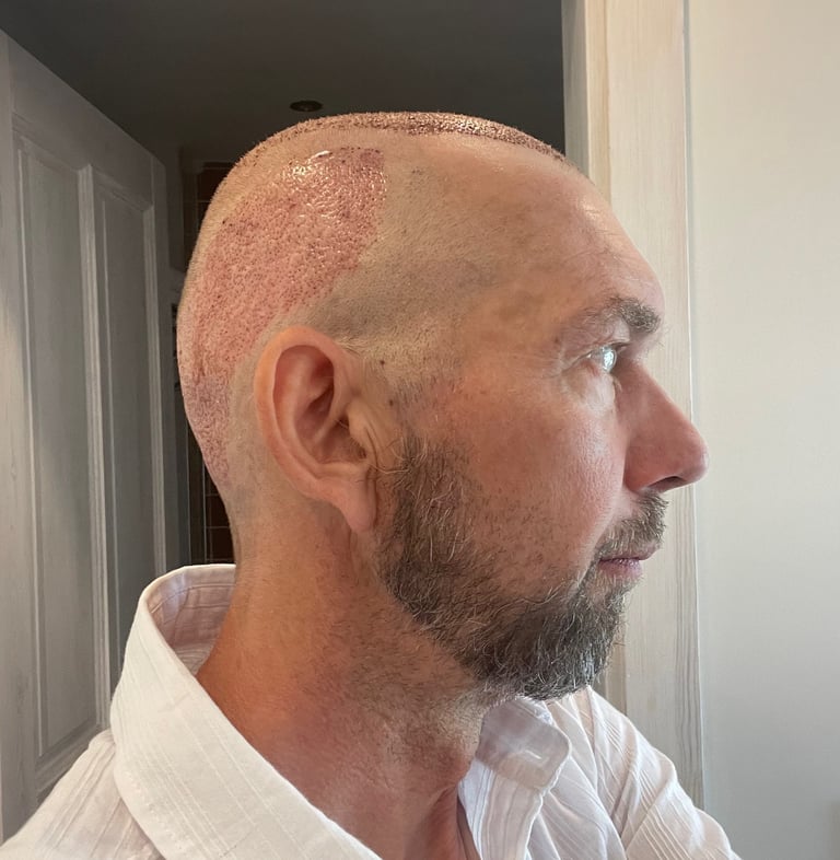 post operation pictures of a hair transplant on a man