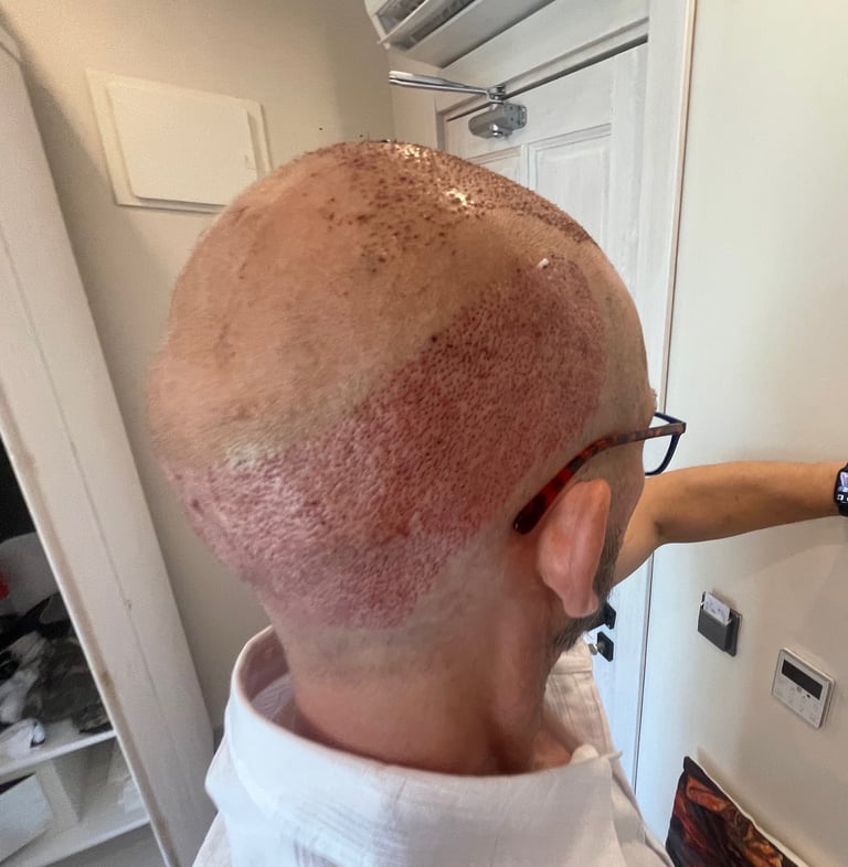 post operation pictures of a hair transplant on a man