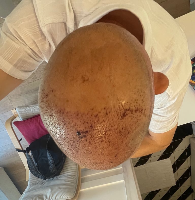 post operation pictures of a hair transplant on a man