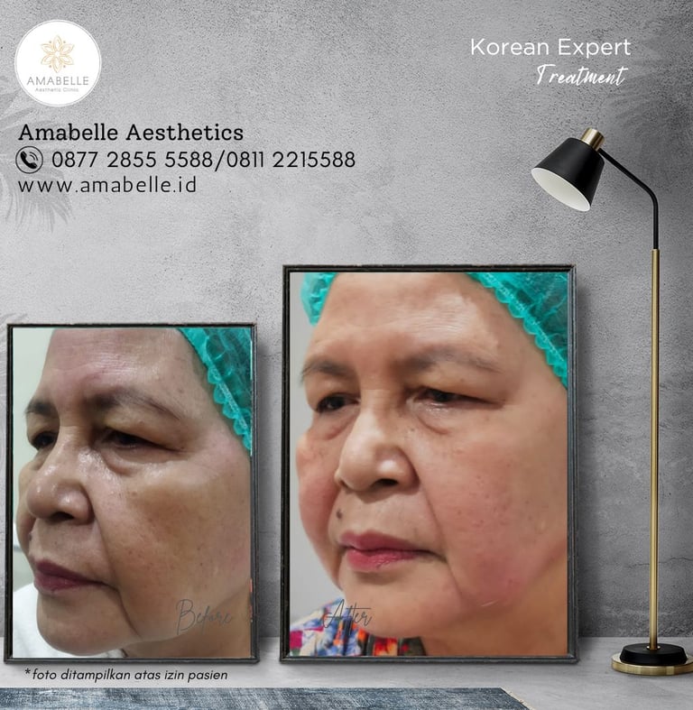 amabelle before after korean expert treatment