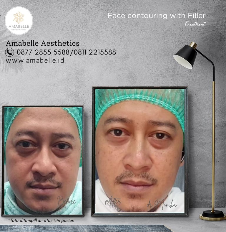 amabelle before after face contouring treatment