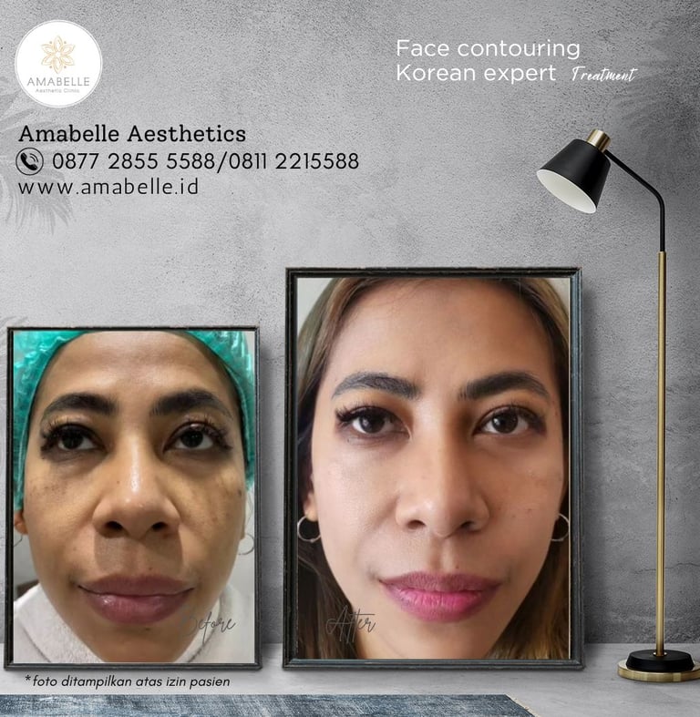 amabelle before after face contouring treatment