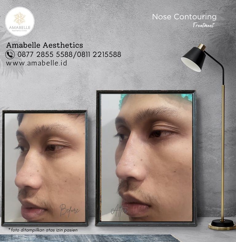 amabelle before after face contouring treatment