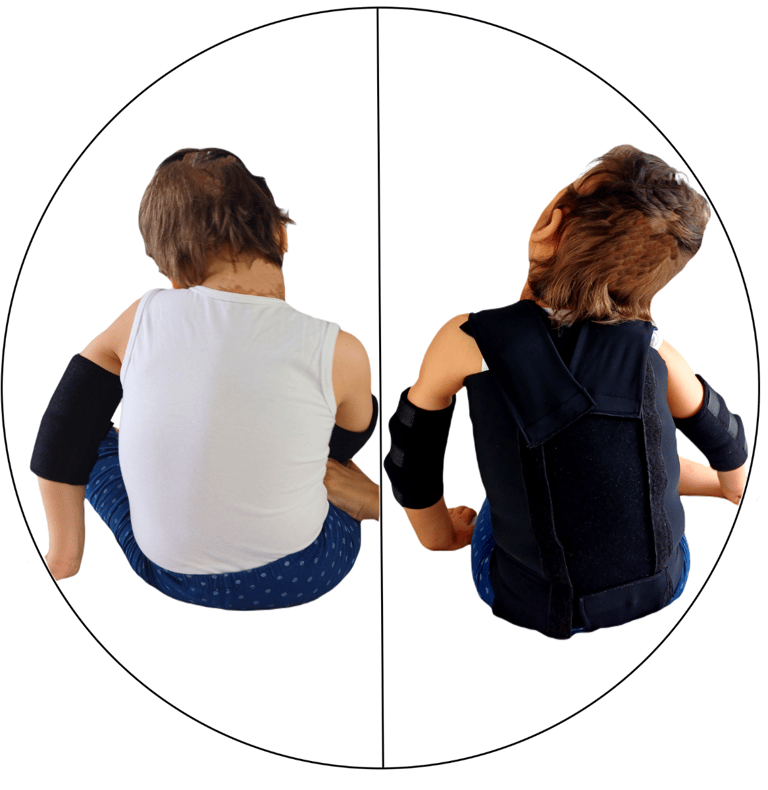 Antes y después con el chaleco corrector postural y sensorial MiSara Hug my Body