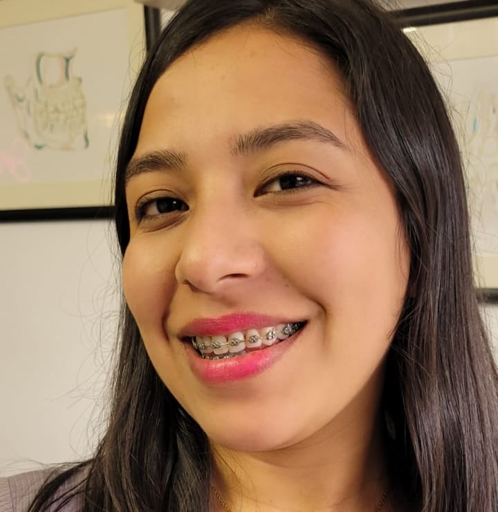 Sonrisa perfecta después de ortodoncia en DUPRINS Lima - Brackets y alineadores dentales