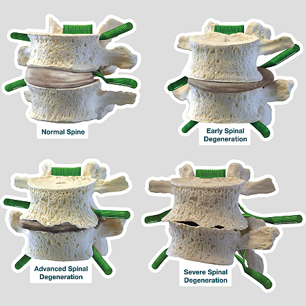 Envelhecimento da coluna vertebral esquematicamente