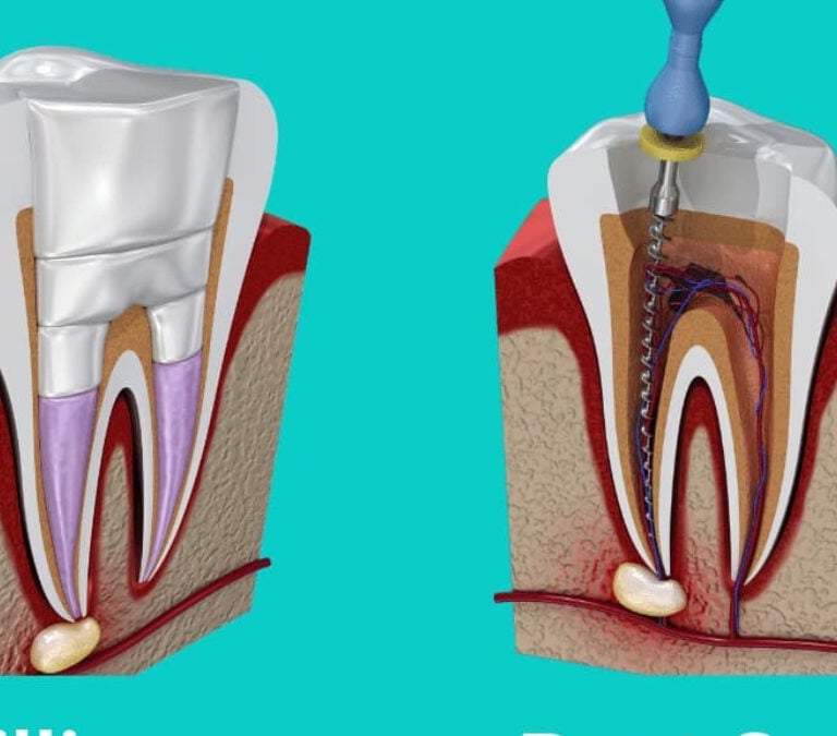 Root canal Treatment at dentosculpt
