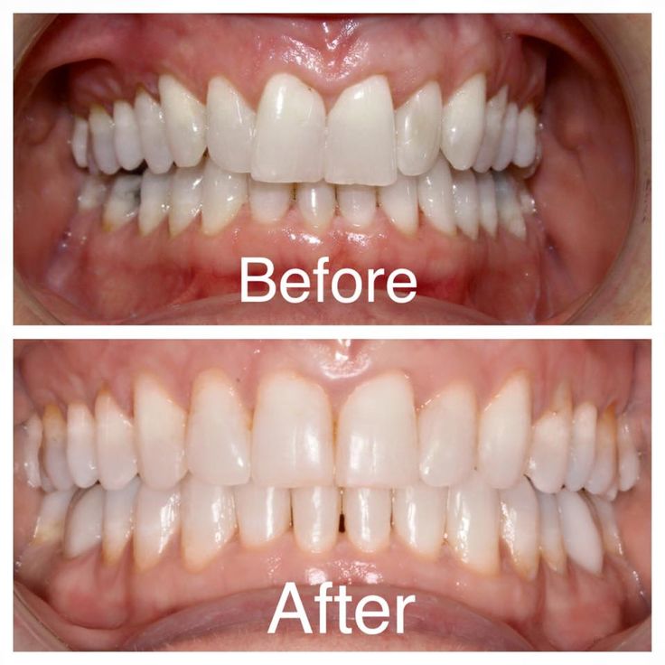 before and after ortho/braces treatment  in white castle dental clinic katraj pune