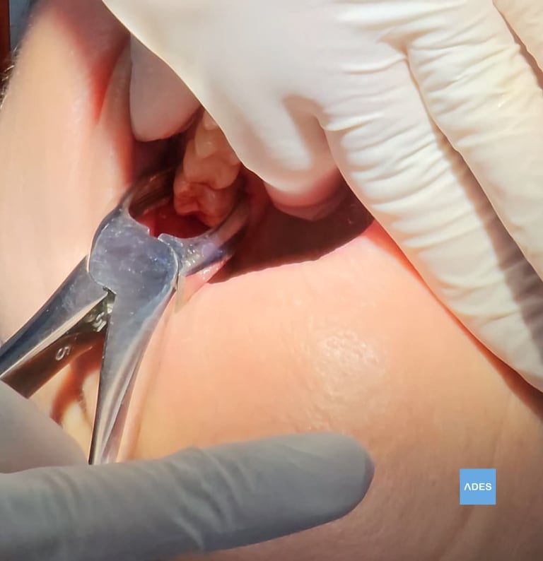 extracción muela juicio