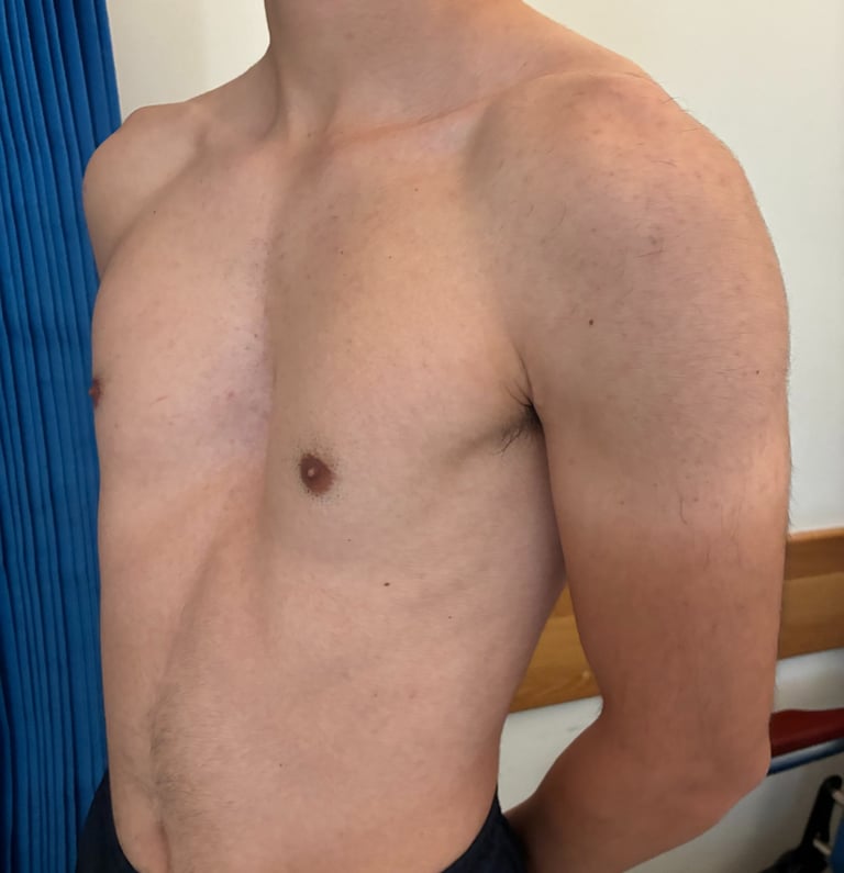 Pectus Excavatum surgery in Malta