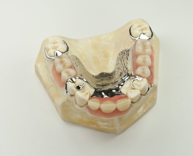 cast partial denture
