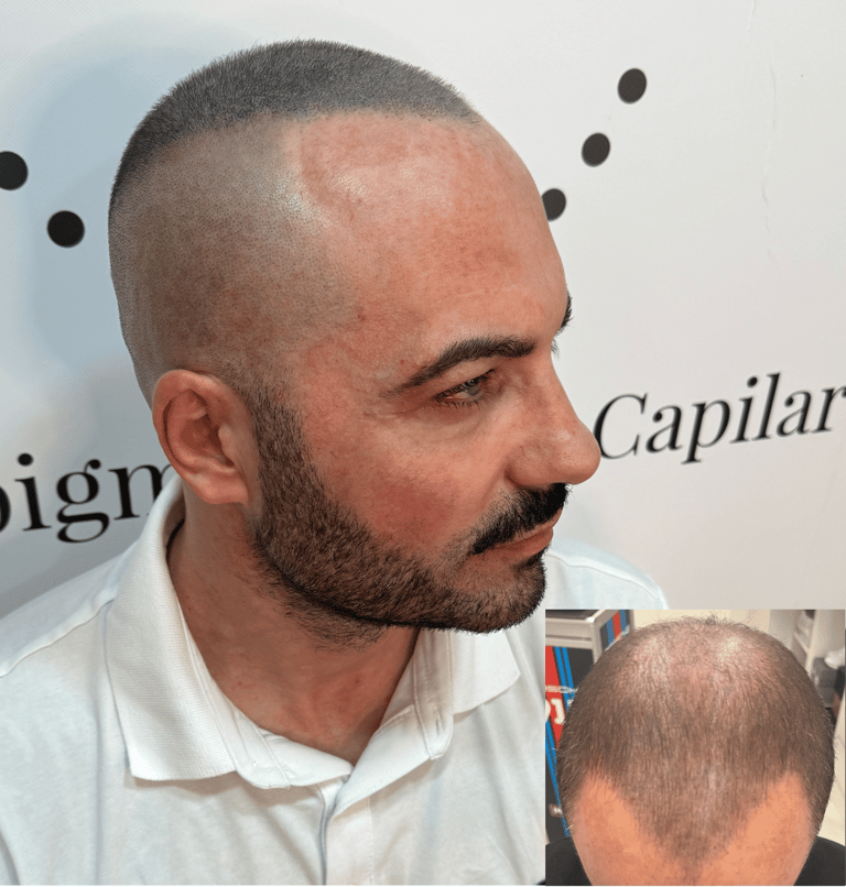 Micropigmentación para disimular calvicie