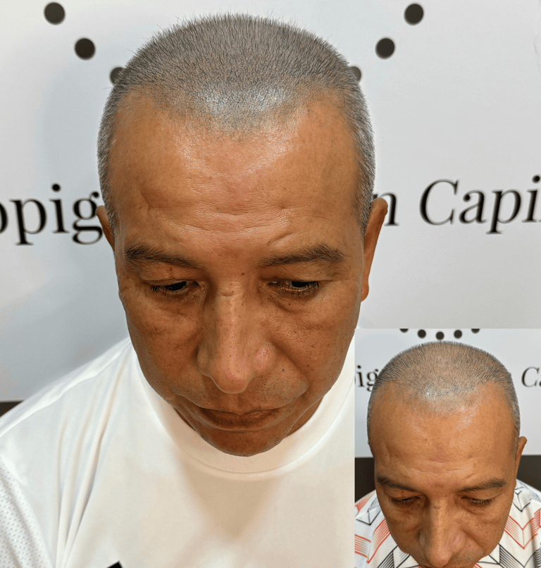 Simulación de folículos capilares post injerto