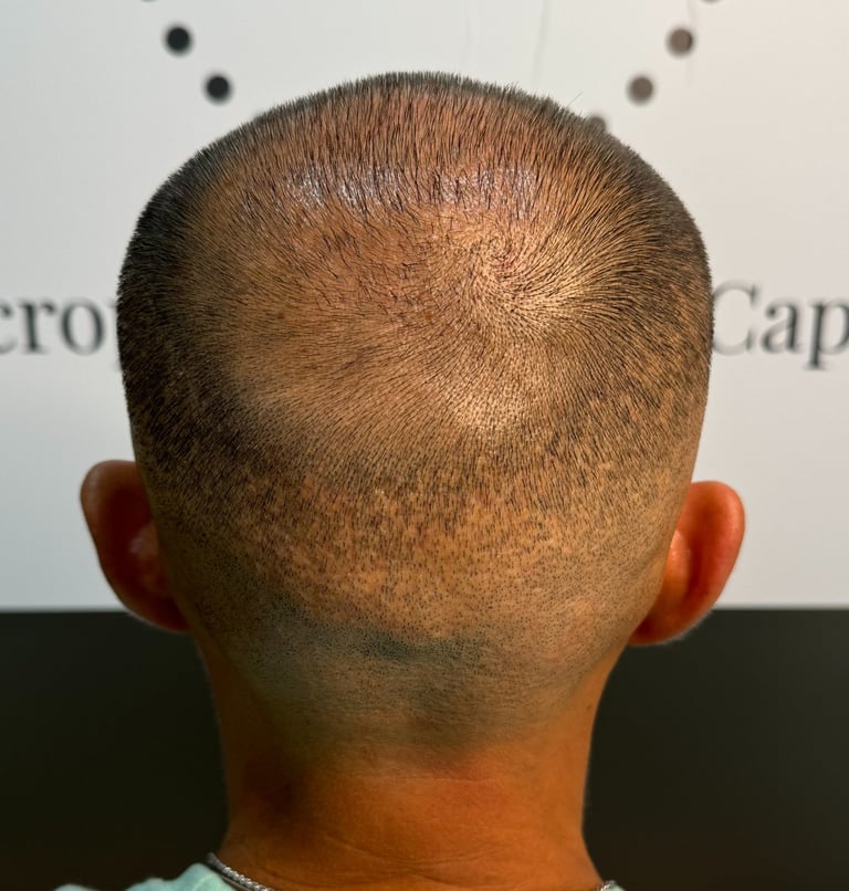 #RecuperaTuZonaDonante #MicropigmentaciónCapilar #ReparaciónZonaDonante #SoluciónCapilar #Reparación