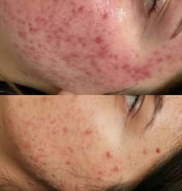 Visible acne improvement after structured skin transformation programme