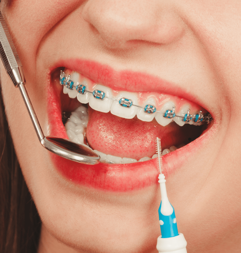 Close-up of traditional metal braces on teeth, demonstrating effective orthodontic treatment