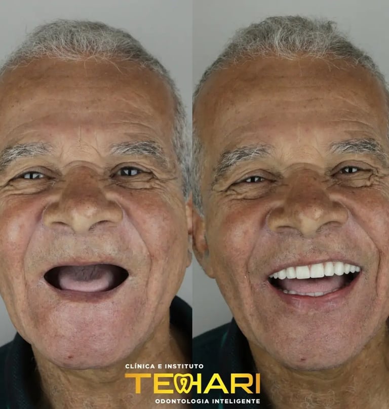 Antes e depois de Implante dentário em Osasco e Americana, Tehari Odontologia