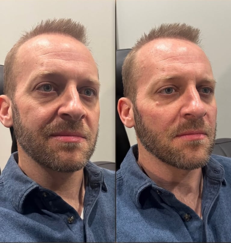 Morpheus8 RF microneedling in Wokingham
