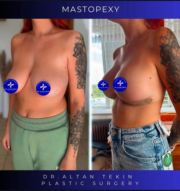 breast lift before after photos in Antalya, Turkey