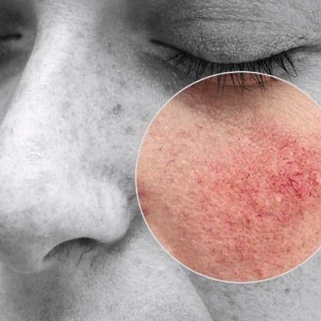 tratamento rosacea em bh