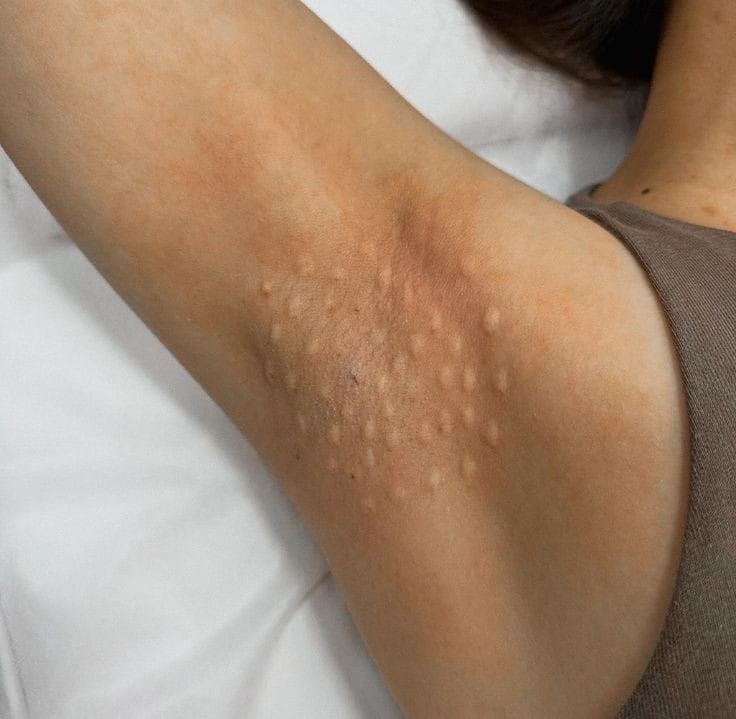 tratamento hiperidrose em bh