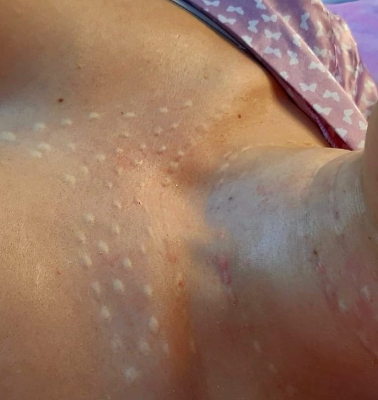 Rejuvenescimento de Colo em BH