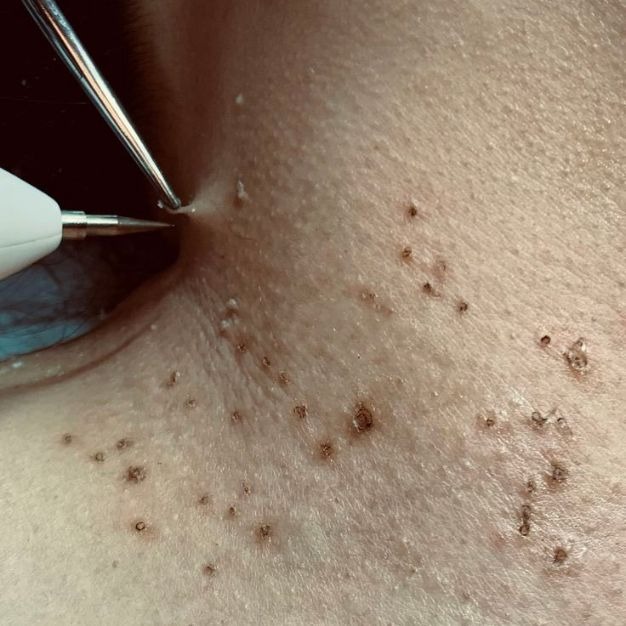 remover verrugas em bh