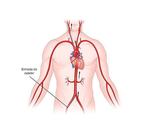 ilustração médica esquemática sobre stent