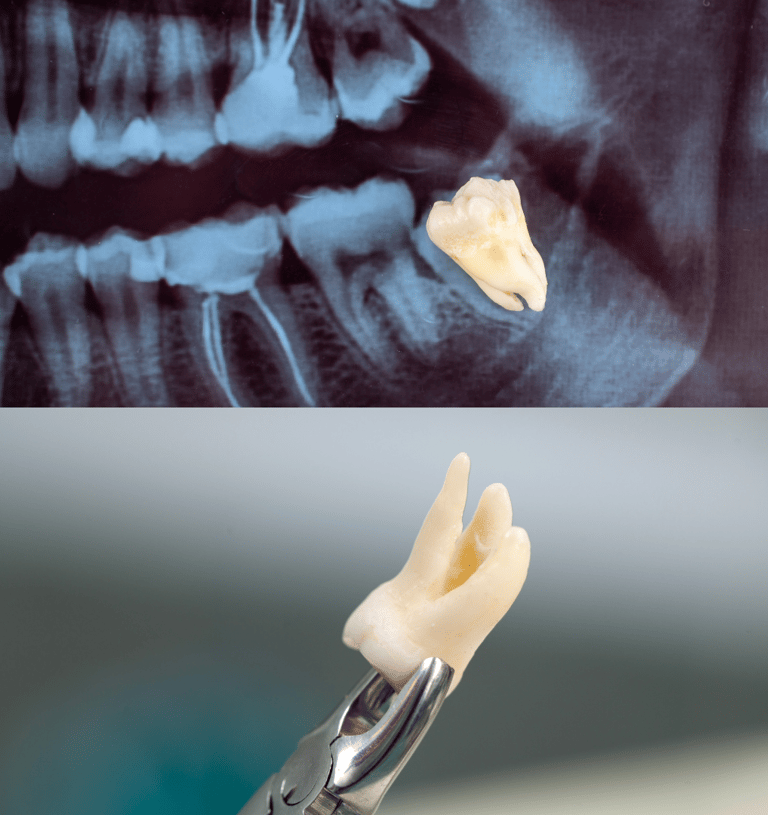 wisdom tooth extraction in Navi Mumbai |  Ekdantam Dental Clinic kopar khairane