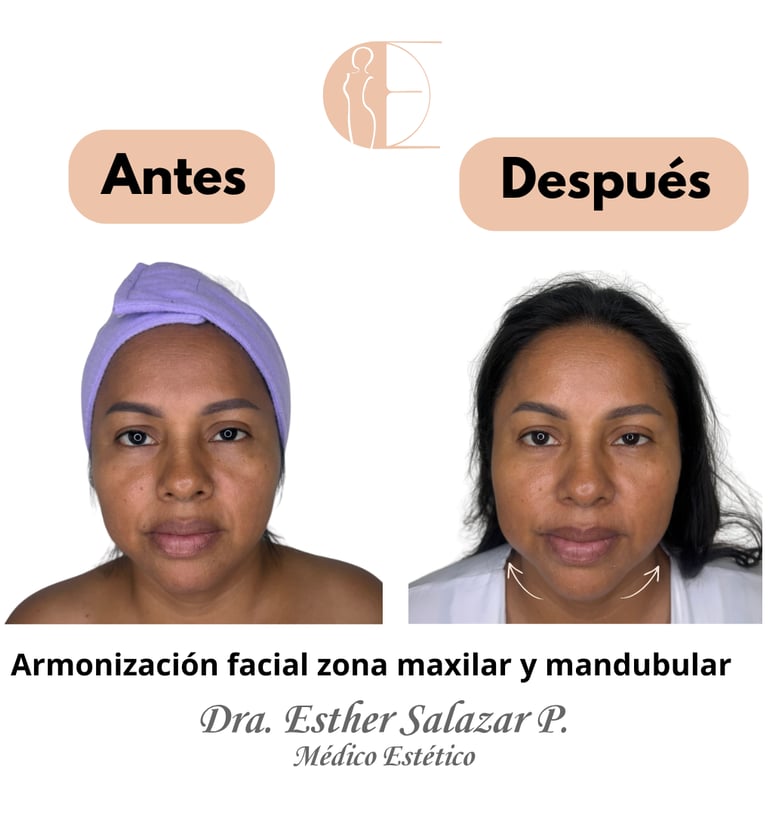Armonización facial zona maxilar y mandubular
