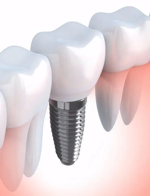 Dental Implant Clinic in Navi Mumbai | Ekdantam Dental Clinic