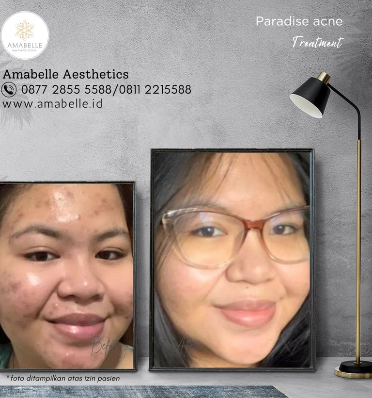 amabelle before after anti acne treatment