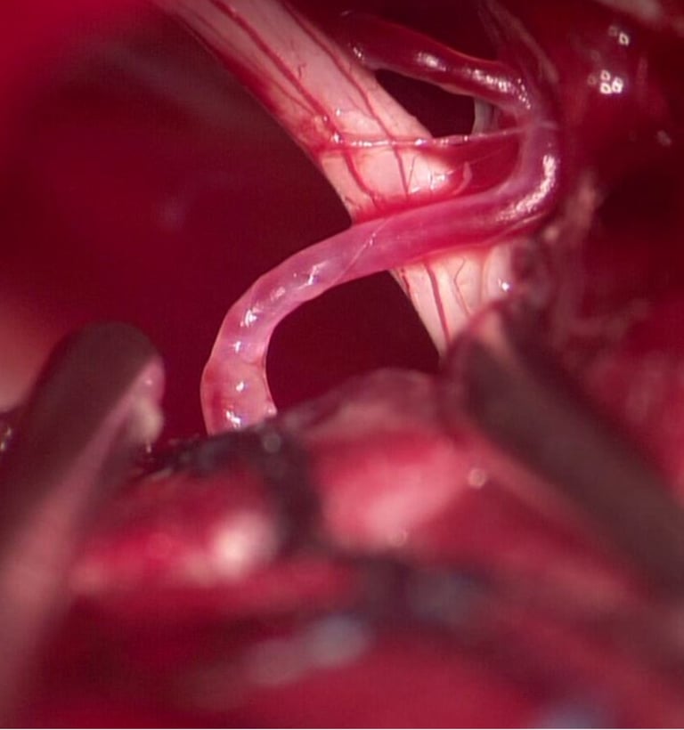 imagen microscopica de cerebro humna muestra una arteria y un nervio durante cirugia