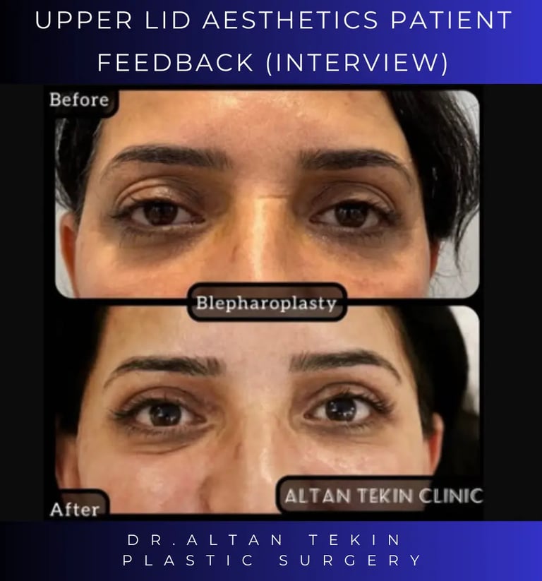 blepharoplasty before after photo in Antalya