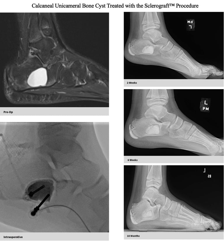 MRI-unicameral-bone-cyst-calcaneus-sclerograft.jpg