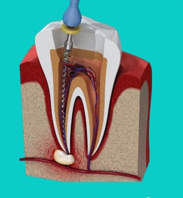 Root canal Treatment at dentosculpt