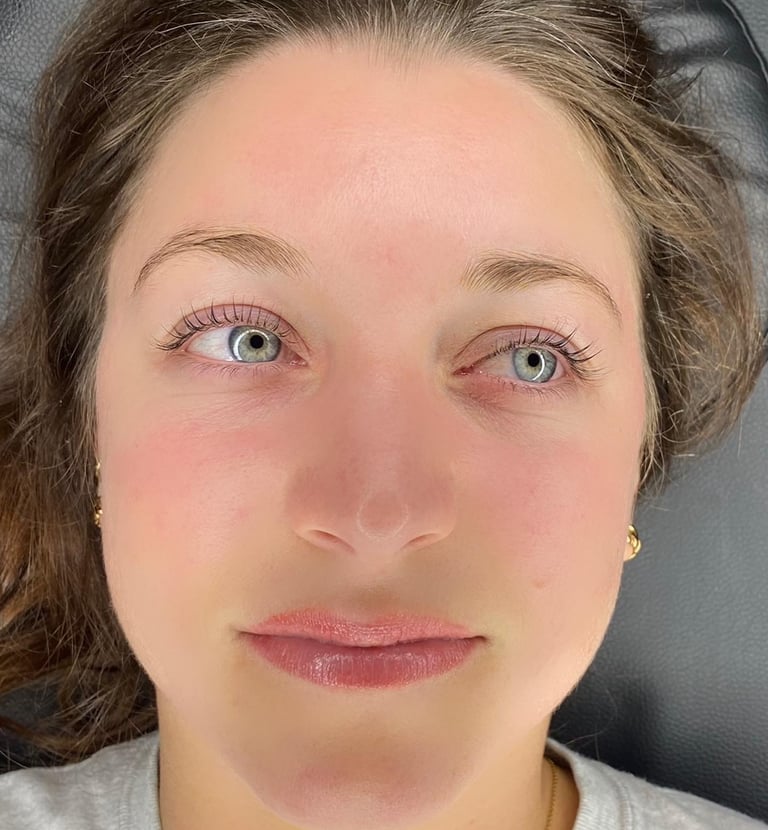 woman after microneedling