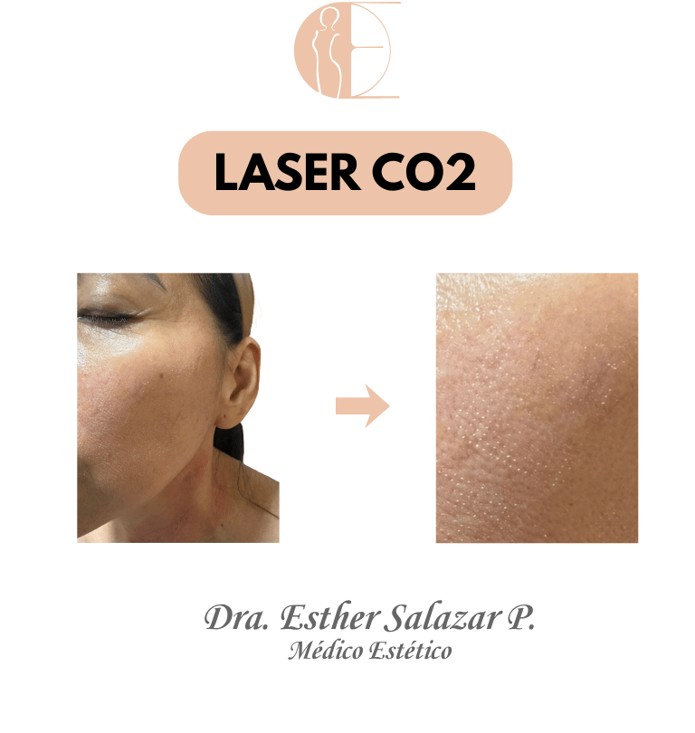 LASER CO2 GUAYAQUIL