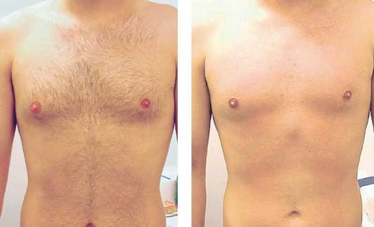 Depilação Abdomem Masculino