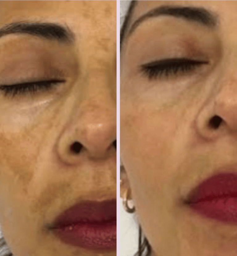 antes y despues de tratamiento facial en señora