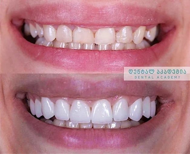 Before and after dental veneers transformation in Tbilisi clinic