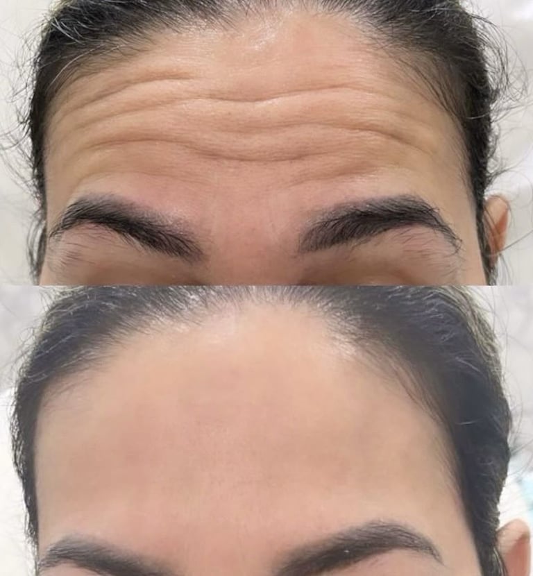 Reduccion de arrugas y lineas de expresion