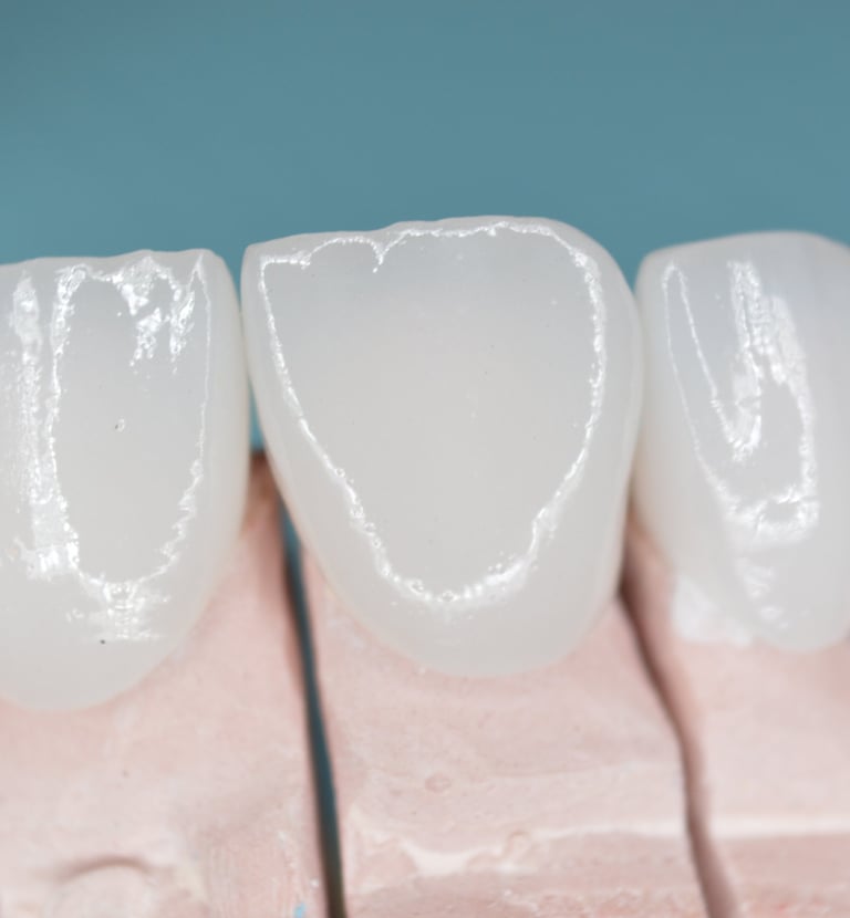 Corona de zirconia en dientes anteriores