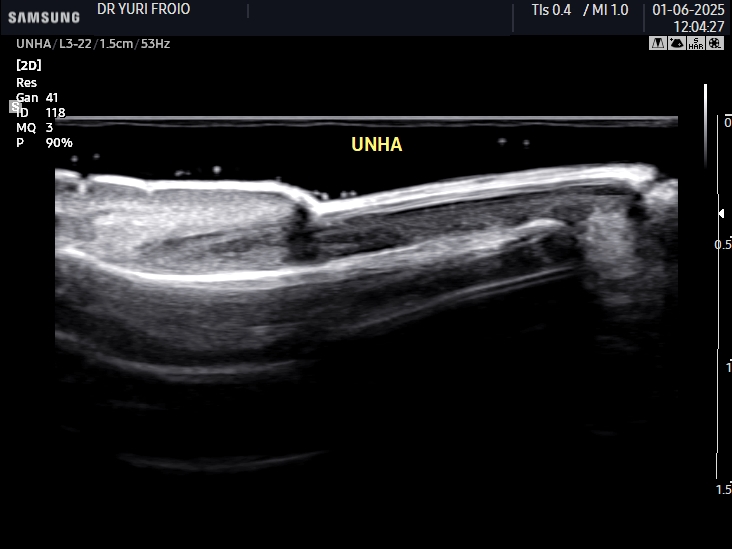 Unha normal com transdutor de alta frequência (22 mhz).