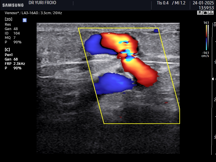 Veia perfurante incompetente.