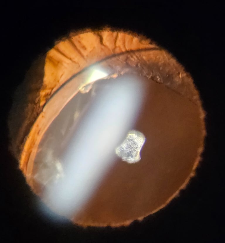 Dislocated Intraocular Lens