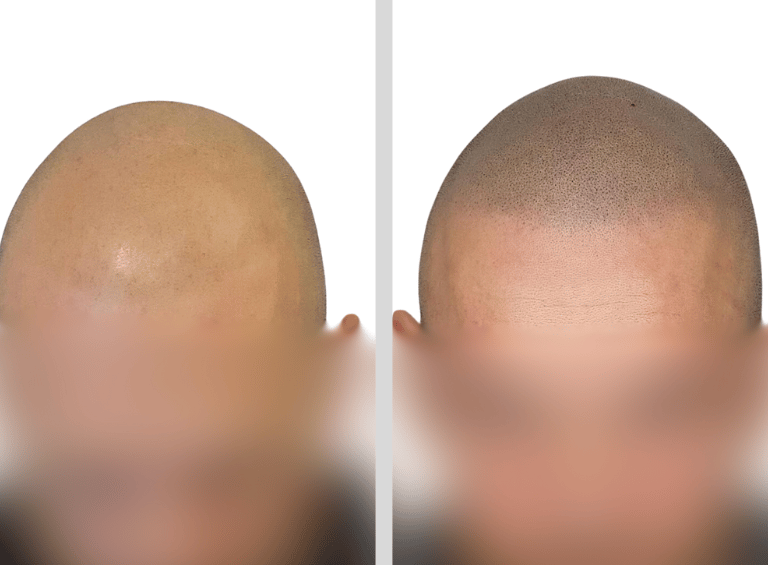 Tricopigmentation Avant Après Calvitie Perte de Densité Capillaire